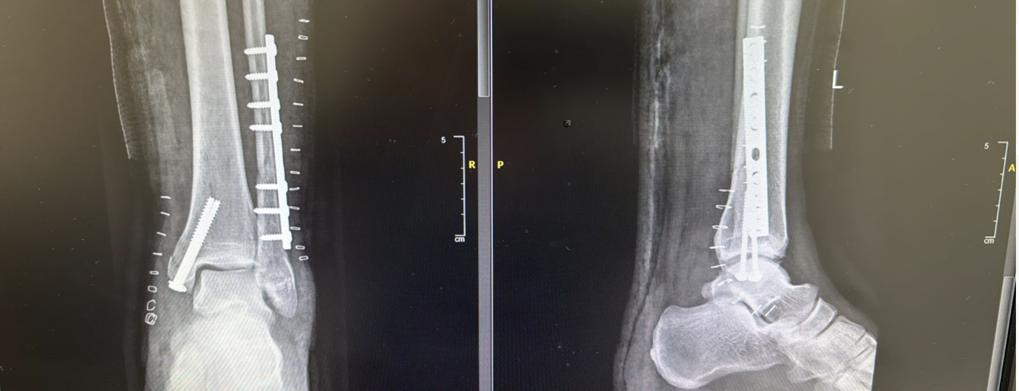 Multiple fractures around the ankle joint