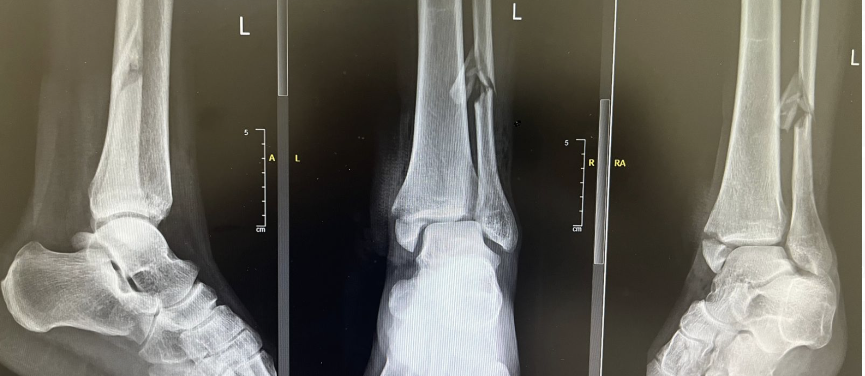 Multiple fractures around the ankle joint